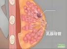 乳腺導(dǎo)管瘤